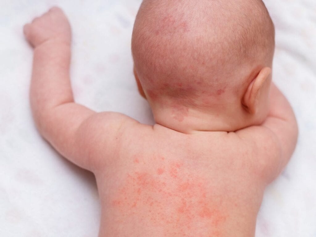 diagonal belønning Udfyld Top 3 Dry Skin Causes for Babies (Plus Solutions) | Waxelene