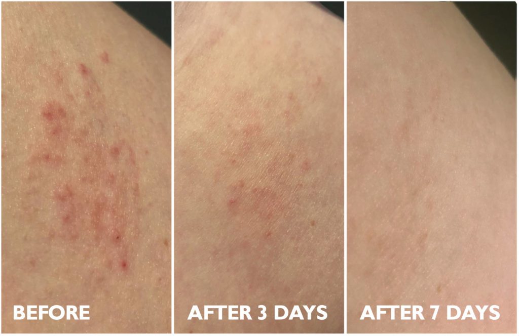 Eczema Rash Before & After