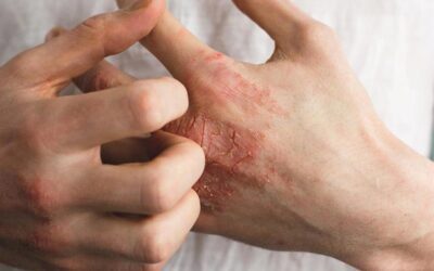 What causes Eczema? Symptoms, causes, and treatment