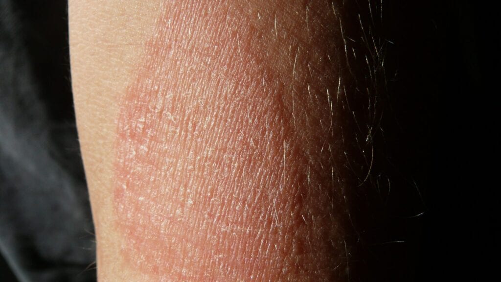 types of eczema