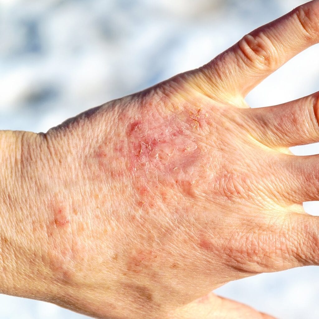 dehydrated skin rash