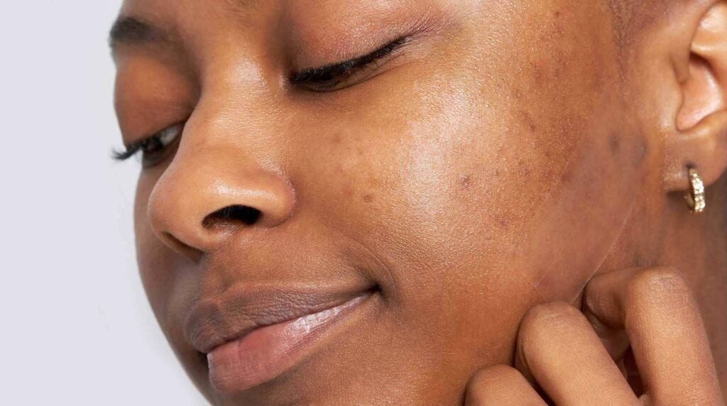 acne scar