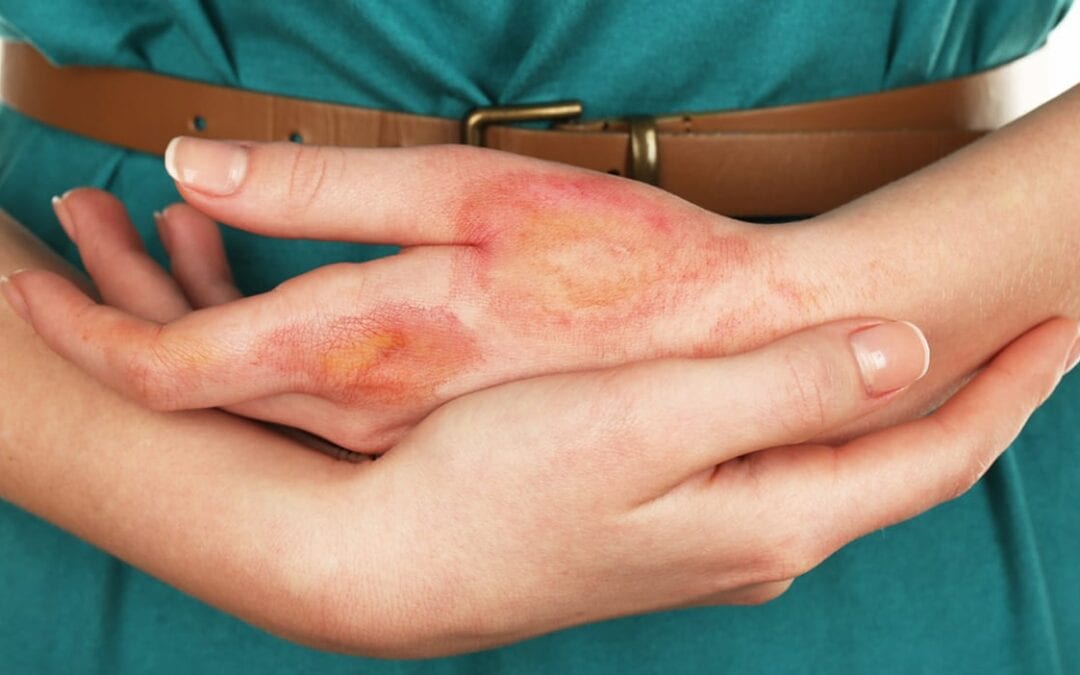 What is the Impact of Burn Scars on Your Skin?