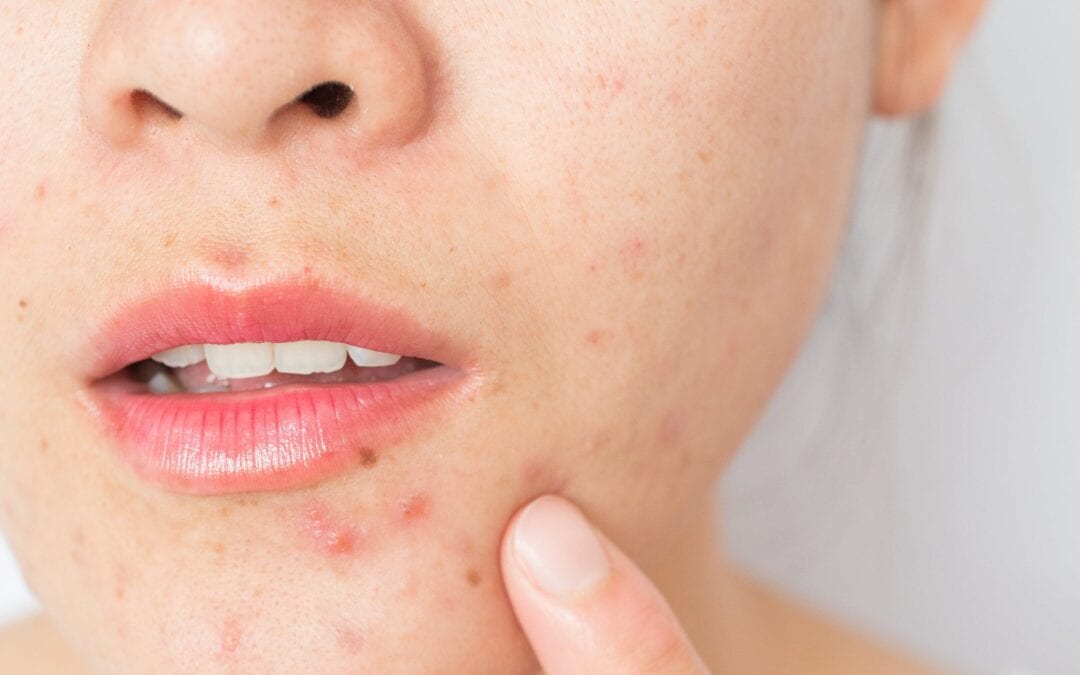 Acne Scars – Causes, Prevention, and Treatment