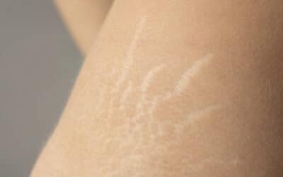 Stretch Marks – Learn Why They Happen – Plus Natural Remedies