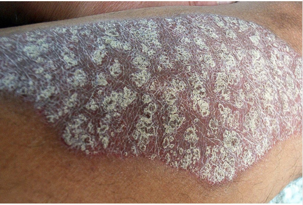 Other Skin Conditions That Look Similar