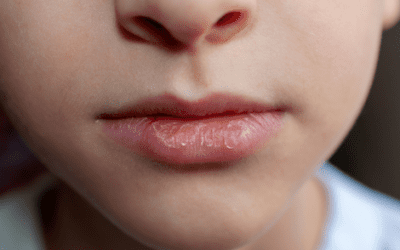 What Causes Chapped Lips?