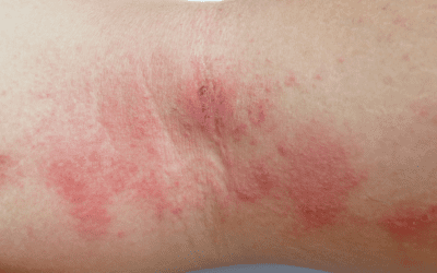 What Does Eczema Look Like?