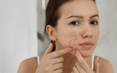 How to Stop Skin Peeling from Acne