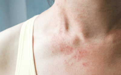 Natural Ingredients for Eczema-Prone Skin