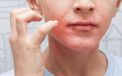 Is There a Cure for Eczema?