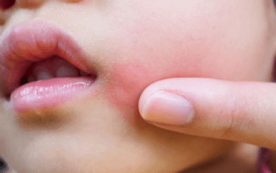 Why is Eczema More Common in Children?