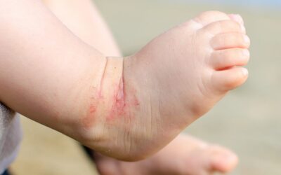 Natural Ingredients for Eczema-Prone Skin